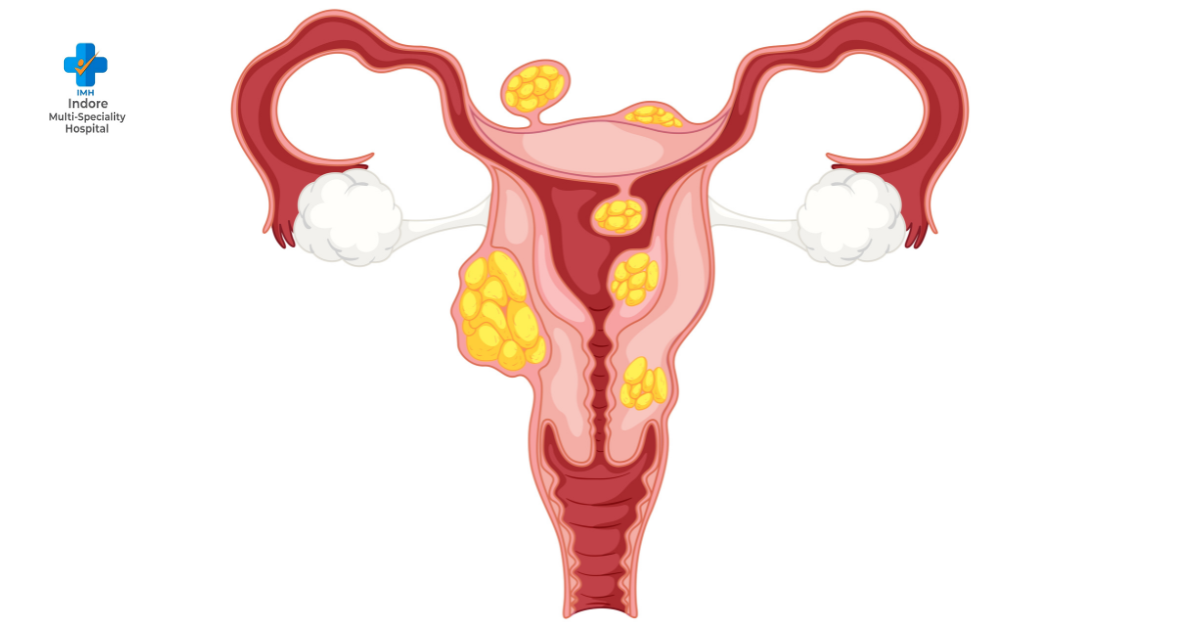 PCOD in Young Women: Early Signs and Prevention Tips