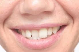 Can protruding teeth correction be done without braces?