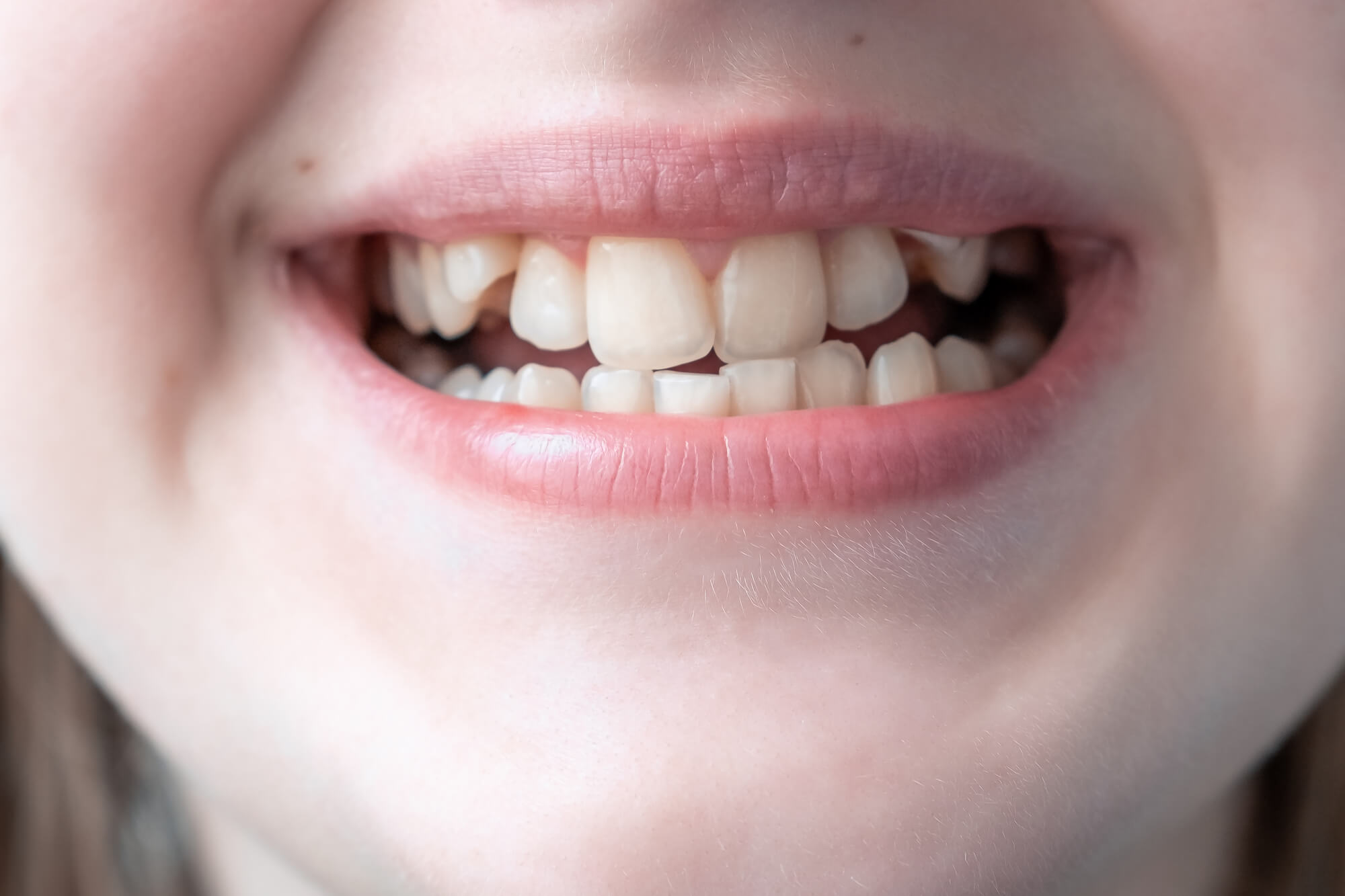 Can Seniors Get Crowded Teeth Corrected?