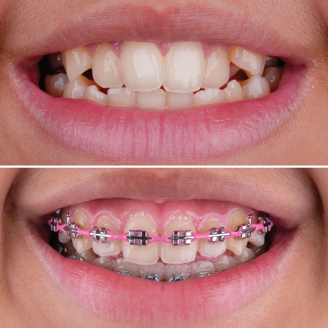Are braces painful to wear long term?