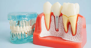 How Long Does It Take to Recover from Dental Implant Surgery?