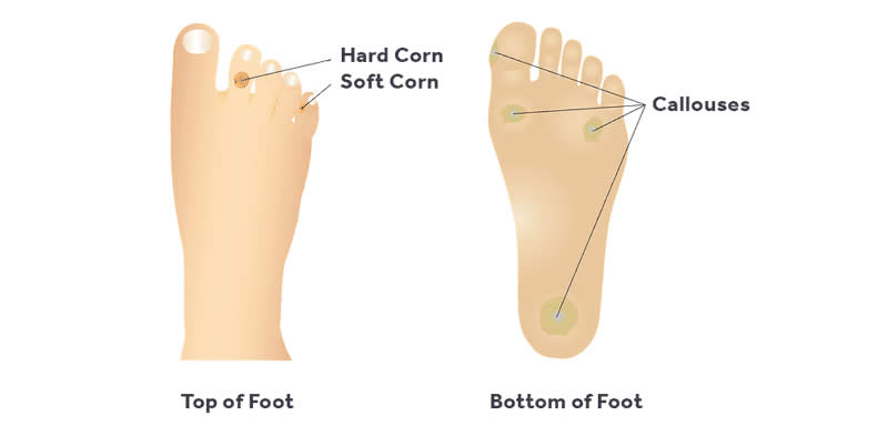 Foot Corn Treatments in Delhi