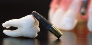 Dental Implant Specialists - How to Find the Right One