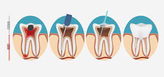 Root Canal Treatment Cost in India