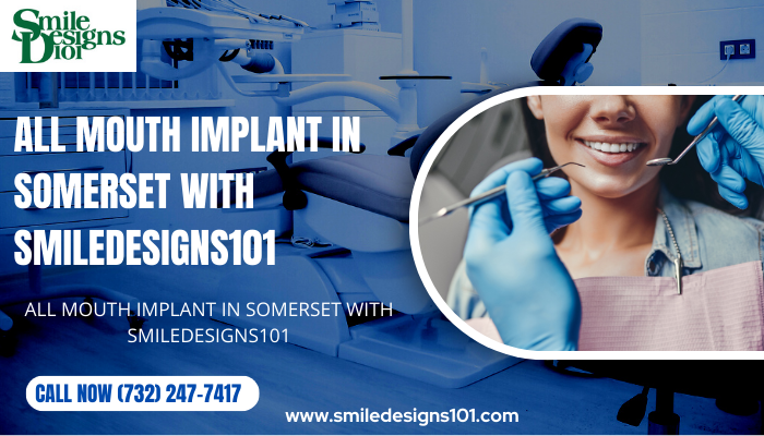 All You Need to Know About All Mouth Implants in Somerset With SmileDesigns101