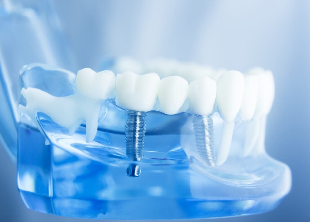 Dental Impression Systems Market Future of cosmetic dentistry , it is Creating Real Change in the digital dentistry Industry