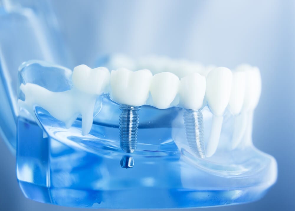 Dental Impression Systems Market Future of  cosmetic dentistry , it is Creating Real Change in the digital dentistry Industry