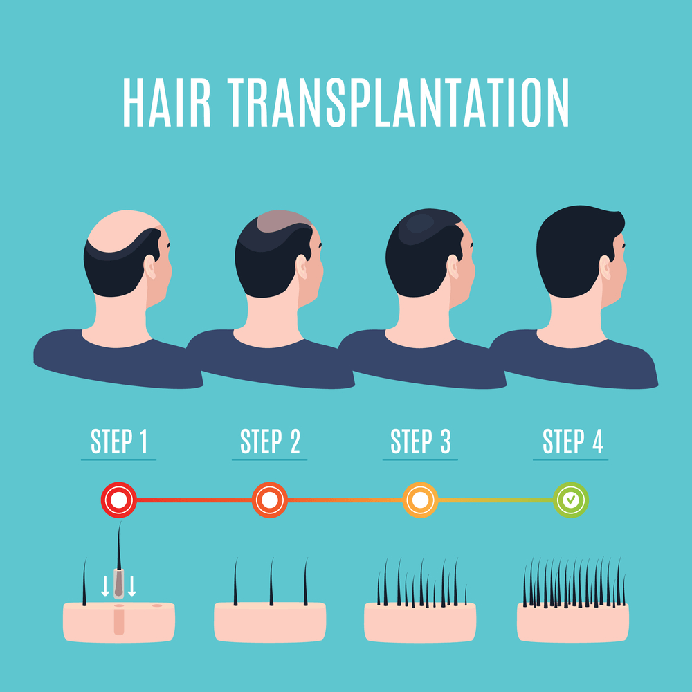 Revolutionized Hair Techniques for Hair Transplant