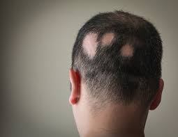 Global Alopecia Treatment Market Report 2020 with Analysis of COVID-19 Impact