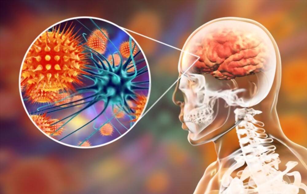 Meningitis Symptoms - Top Five Symptoms of Meningitis