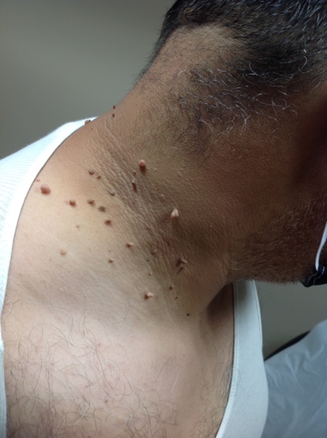 Laser Skin Tag Removal Procedure- An Effective and Safe Treatment