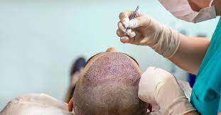 What is Shock Hair Loss After Surgery?