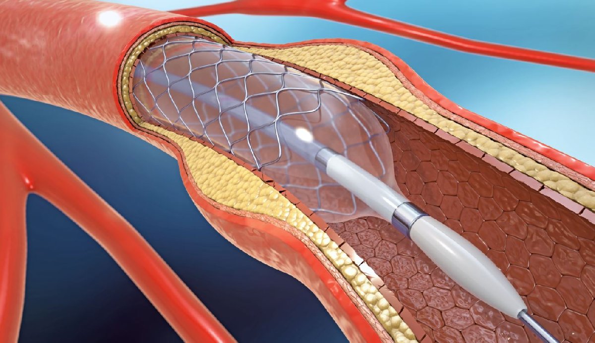 India Coronary Stents Market to Experience High Growth Driven by Increasing Demand and Technological Advancements