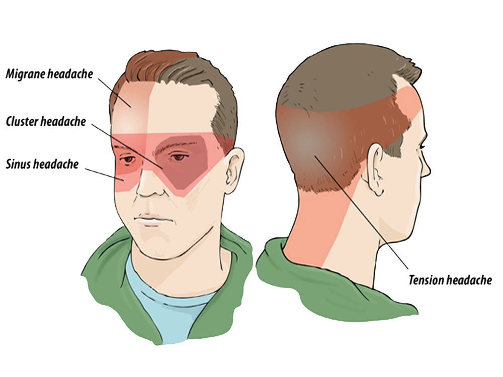 Cluster Headaches Cause OneSided Head Pain With Tearing Of The Eyes