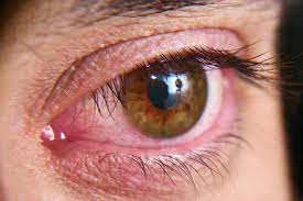 Dry Eye Syndrome Market Size, Share, Growth, Opportunities and Global Forecast to 2028