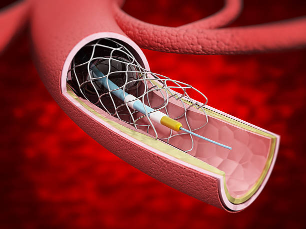 Coronary Stents Market Future Scenarios and Business Growth Segment, Drivers, Trends, Forecast to 2027