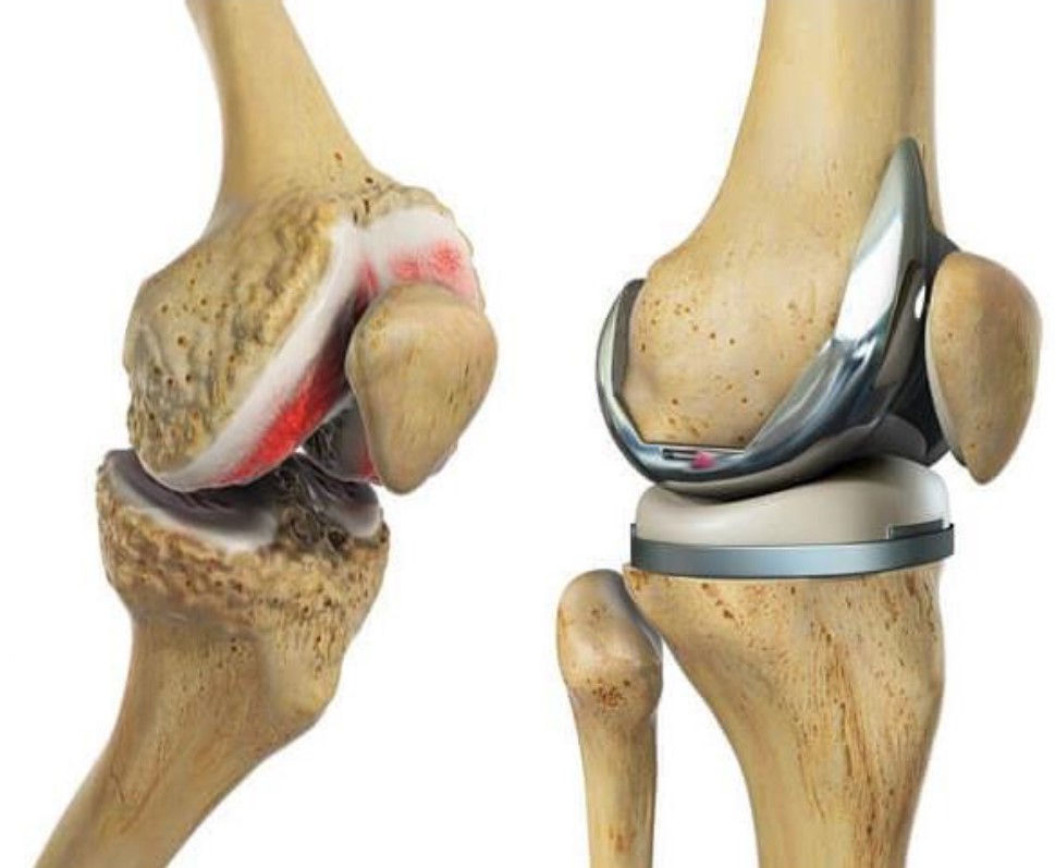 The Growing Total Knee Arthroplasty Market