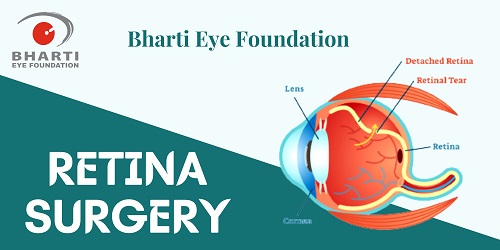 Best Eye Hospital in India for Retina | Retina Hospital in Delhi | Bharti Eye Foundation