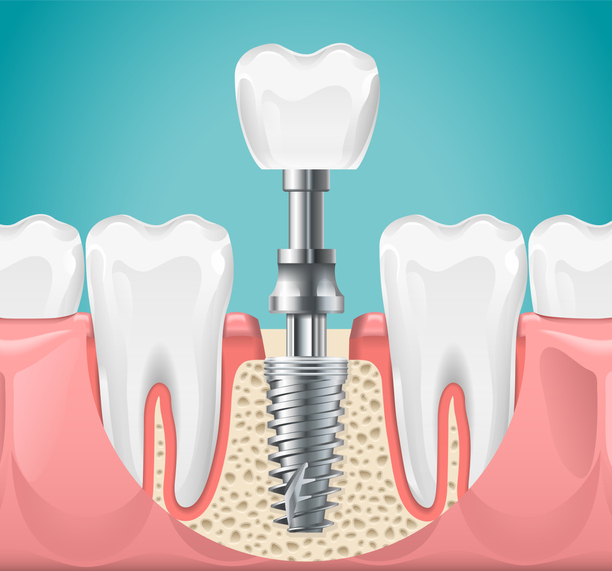 Why Should You Look into Dental Implants?