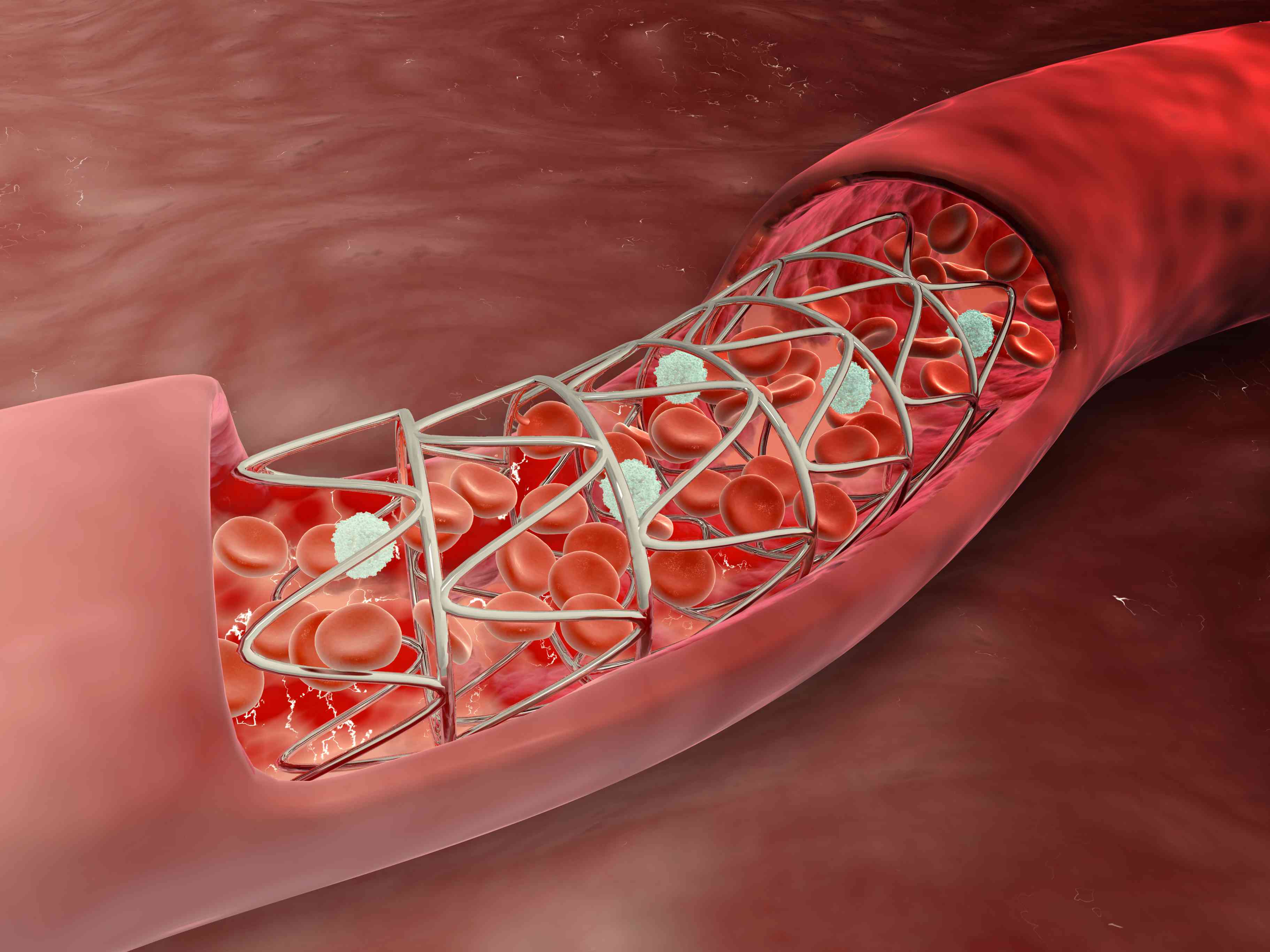 Coronary Arteries Stent Market Size, Key Players Analysis And Forecast To 2028 | Value Market Research