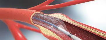 Global Coronary Stent Market to Grow by CAGR of ~6% During 2022 – 2031 On The Back of Rising Cases of Heart Attacks