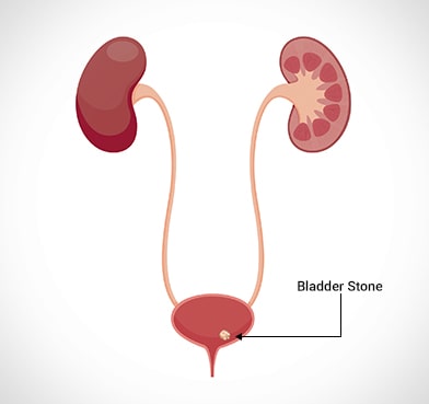 Why do Bladder Stones Need Early Treatment?