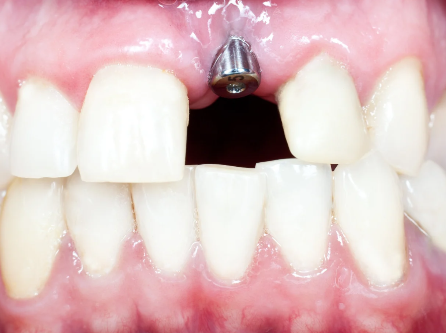 Dental Implant Success Rate and Why It¡¯s a Trusted Solution