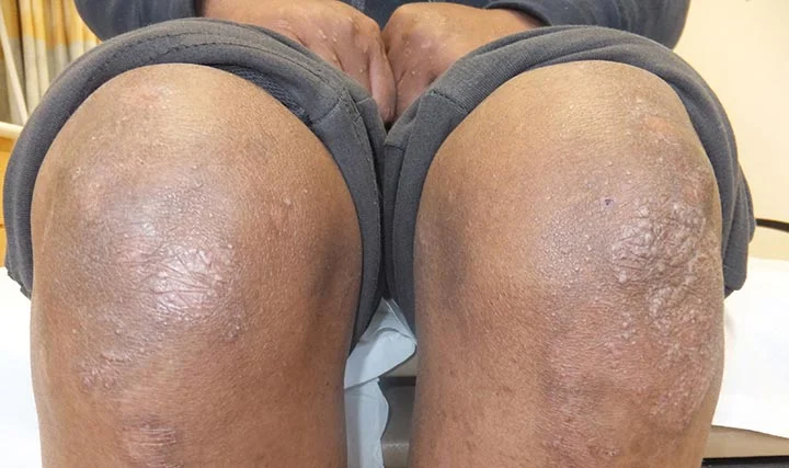 Dystrophic Epidermolysis Bullosa Market Size 2023: Epidemiology, Industry Trends and Forecast by 2033