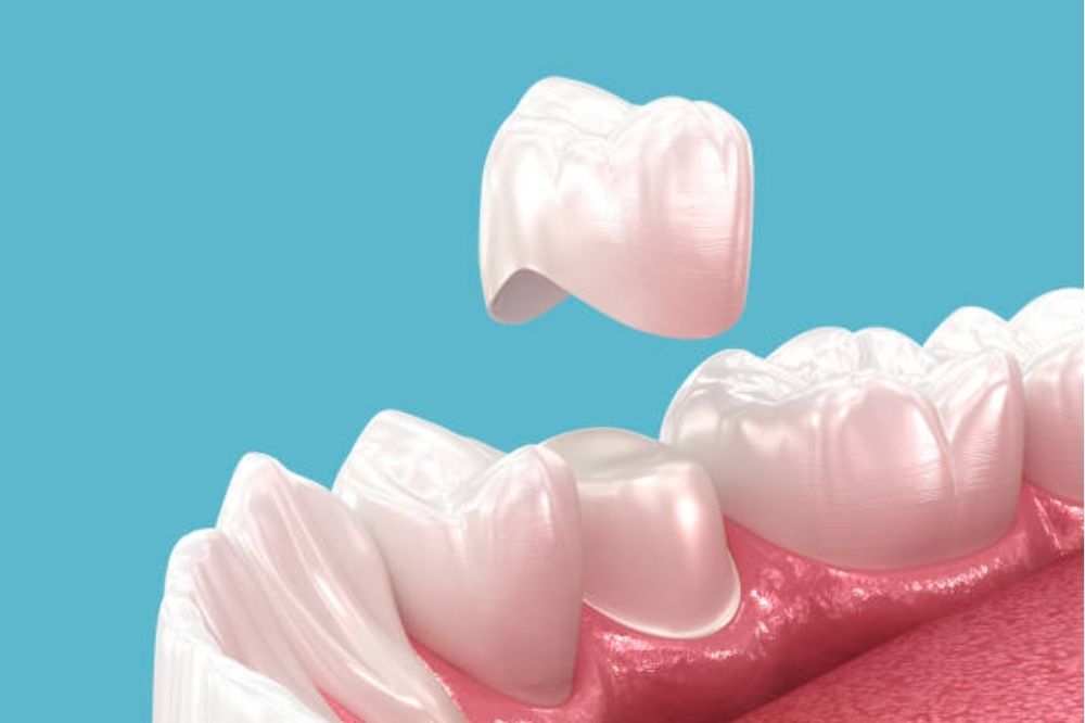 How Dental Crowns Can Restore Your Smile