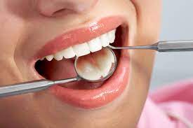 What is a Dental Filling and How Can They Go Wrong?