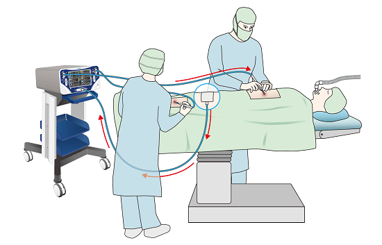 Exploring the Bipolar Electrosurgical Devices Market: Detailed Insights on Size, Growth Potential