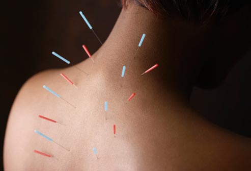 Global Acupuncture Needle Market Growth Opportunities From 2020 To 2024