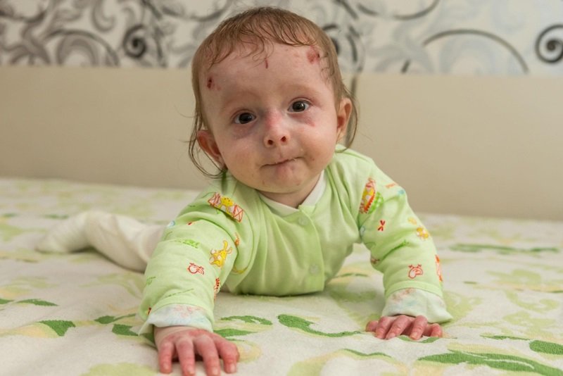 Epidermolysis Bullosa Market Growing Demand For Effective Treatment Solutions