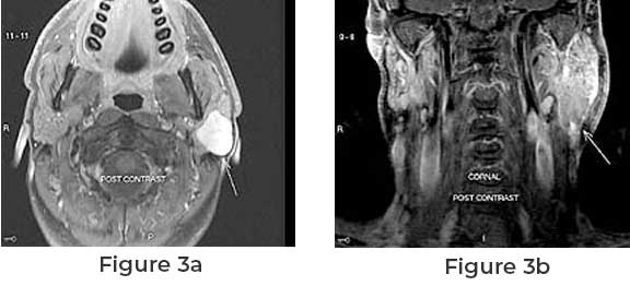 Alpha Surgical Group: Specialized Care for Pleomorphic Adenoma in the USA