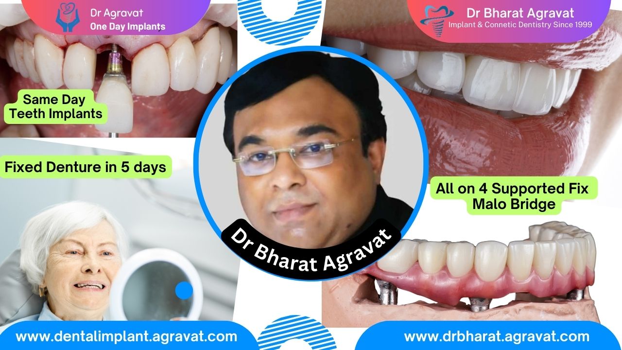 Best Dentist for Full Mouth Dental Implants Clinic in Ahmedabad: Dr. Bharat Agravat, the  top Implantologist 