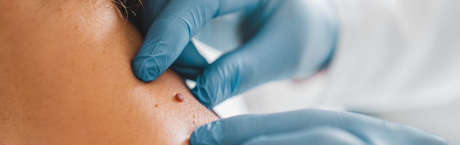 How to Budget for Skin Tag Removal in Bangalore