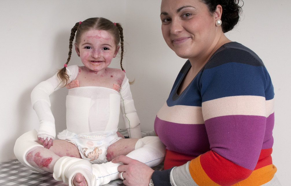 Epidermolysis Bullosa Market is estimated to Witness High Growth Owing to Advancements in Gene Therapy