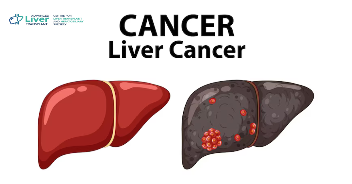 Can Fatty Liver Lead to Cancer? Understanding the Connection