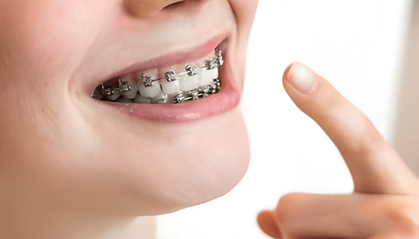 Braces Treatment Costs in Dubai Explained