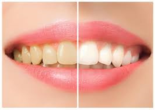 Teeth Whitening Dubai: Tips from Top Dental Experts