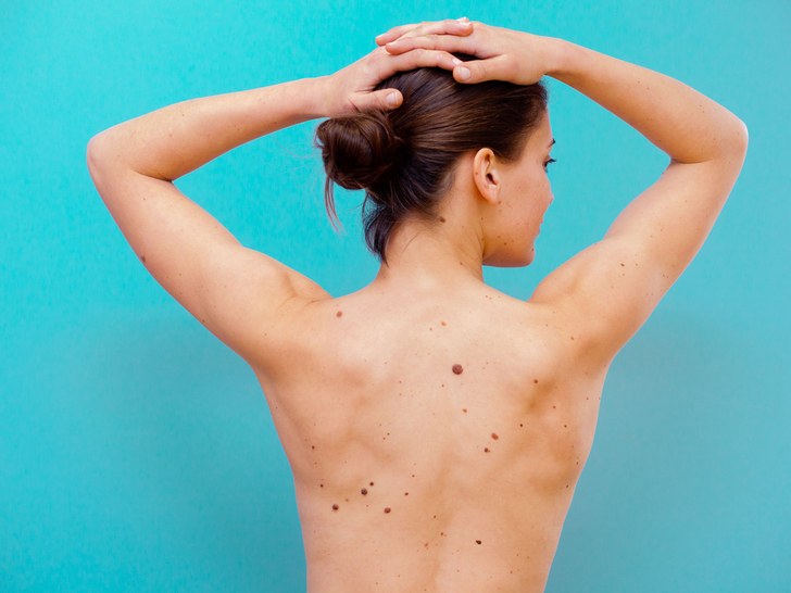 Easy Skin Tag Removal Home Remedy