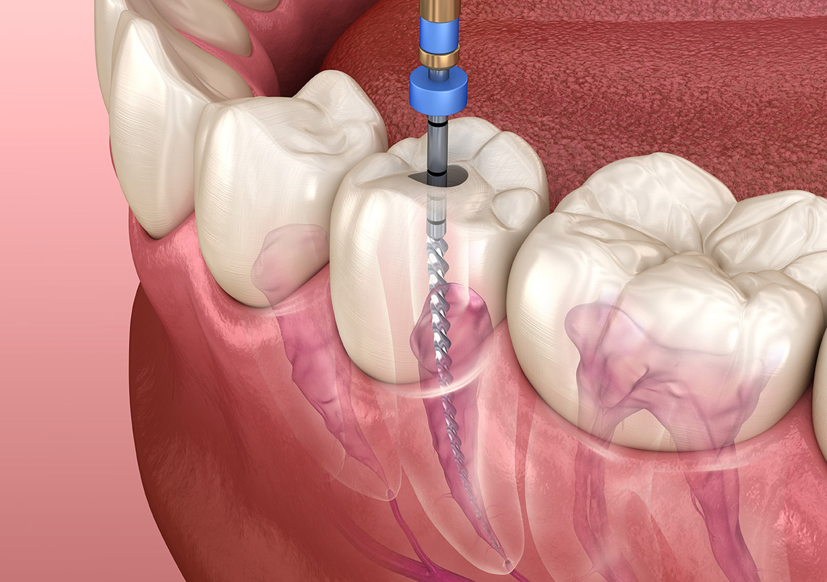 Finding a Root Canal Specialist Near Me: A Comprehensive Guide to Dental Care