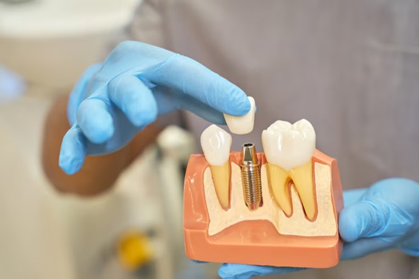 Smile Confidently: How Dental Implant Bridges Restore Function and Aesthetics